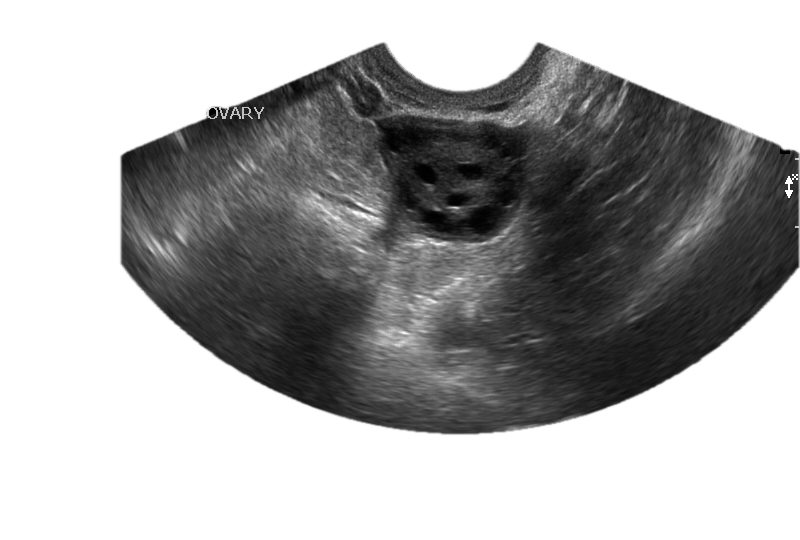 Point-of-care ultrasound — ovary